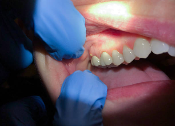 Best Emergency Treatment for Oral Infections in Canadian, TX